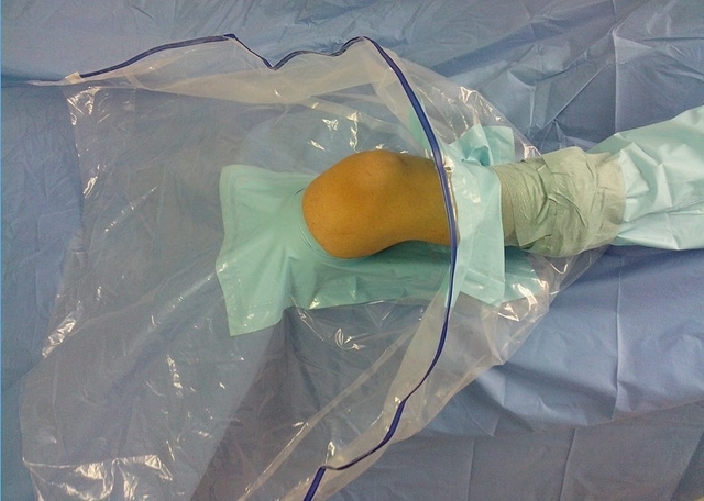 Knee Arthroscopy Disposable Patient Drapes Lower Extremity Orthopedic Class II